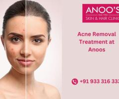Advanced Acne removal treatment in Hyderabad